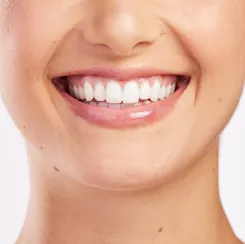 teeth whitening service photo